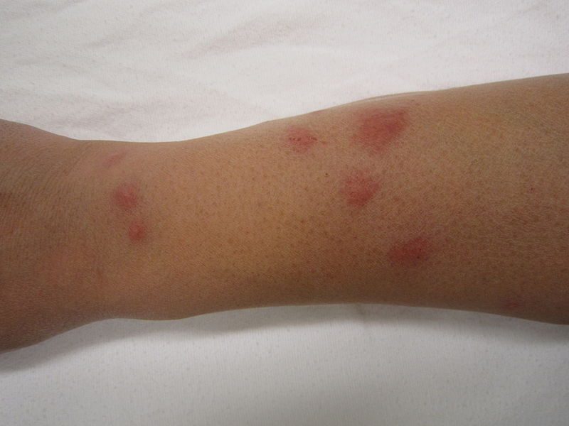 bedbug bites photos