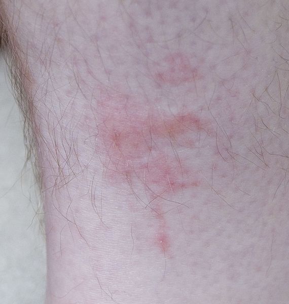 bedbug bites pictures